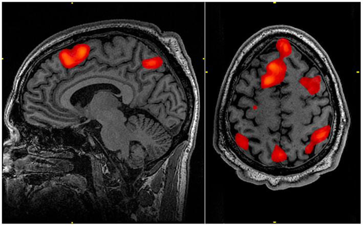 MRI showing brain activity